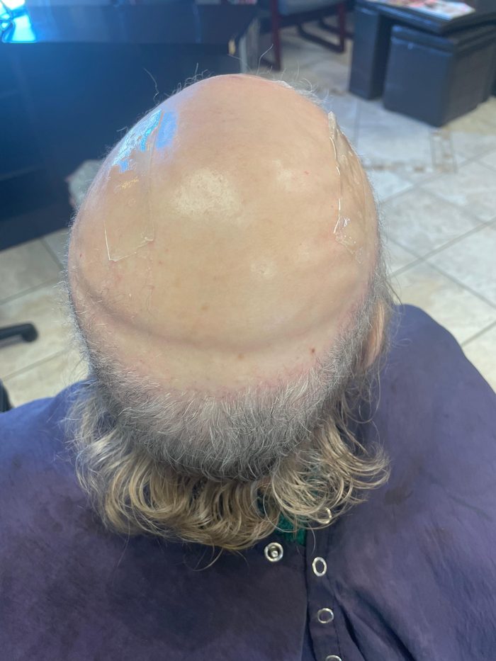 Client 1 before hair restoration